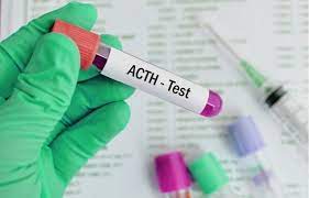 آزمایش ACTH