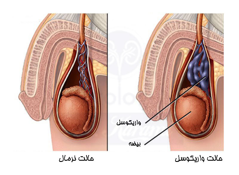 مروری بر بیماری واریکوسل و یافته های آزمایشگاهی