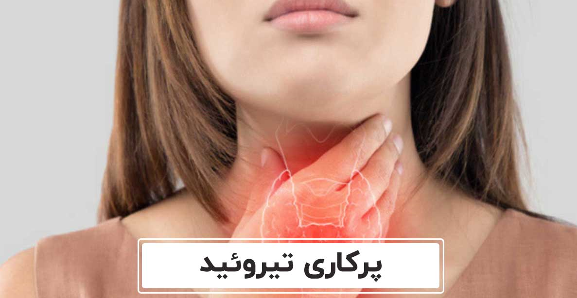 پرکاری تیرویید